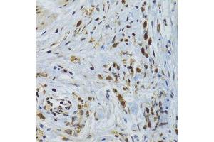Immunohistochemistry of paraffin-embedded human gastric cancer using GABPB1 Antibody. (GABPB1 抗体  (AA 231-395))
