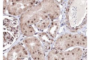 ABIN6267703 at 1/100 staining human kindey carcinoma tissue sections by IHC-P. (PRKAB1 抗体  (pSer181))