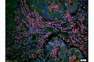 Formalin-fixed and paraffin embedded human breast cancer labeled with Anti TIEG1/KLF10 Polyclonal Antibody, Unconjugated (ABIN735173) at 1:200 followed by conjugation to the secondary antibody Goat Anti-Rabbit IgG, PE conjugated used at 1:200 dilution for 40 minutes at 37°C. (KLF10/TIEG1 抗体  (AA 423-480))