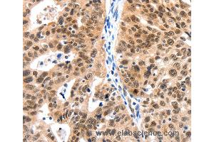 Immunohistochemistry of Human ovarian cancer using LRP5 Polyclonal Antibody at dilution of 1:115 (LRP5 抗体)