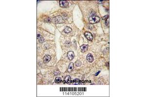 Formalin-fixed and paraffin-embedded human lung carcinoma tissue reacted with CD14 antibody (N-term), which was peroxidase-conjugated to the secondary antibody, followed by DAB staining. (CD14 抗体  (N-Term))