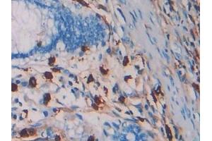 Detection of TPS in Human Colorectal cancer Tissue using Monoclonal Antibody to Tryptase (TPS) (TPSAB1 抗体  (AA 161-262))