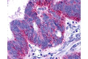 Anti-EDNRB / Endothelin B Receptor antibody IHC of human Colon, Carcinoma.