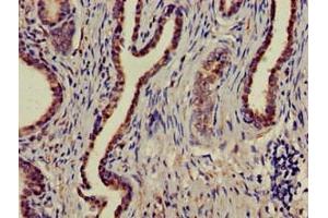 Immunohistochemistry of paraffin-embedded human prostate cancer using ABIN7160004 at dilution of 1:100 (MAPK6 抗体  (AA 383-712))