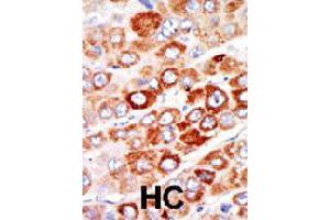 Formalin-fixed and paraffin-embedded human hepatocellular carcinoma tissue reacted with AK1 polyclonal antibody  , which was peroxidase-conjugated to the secondary antibody, followed by AEC staining. (Adenylate Kinase 1 抗体  (C-Term))