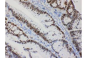 Anti-MCM2 antibody, IHC(P) IHC(P): Human Intestinal Cancer Tissue (MCM2 抗体  (C-Term))