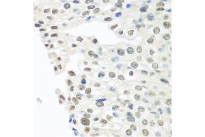 Immunohistochemistry of paraffin-embedded human prostate cancer using TARDBP antibody.