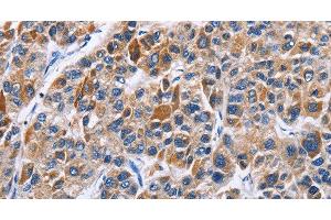 Immunohistochemistry of paraffin-embedded Human liver cancer tissue using ENPP5 Polyclonal Antibody at dilution 1:40 (ENPP5 抗体)