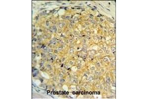 RNASEK Antibody (Center) (ABIN651452 and ABIN2840246) IHC analysis in formalin fixed and paraffin embedded human prostate carcinoma followed by peroxidase conjugation of the secondary antibody and DAB staining. (Ribonuclease K 抗体  (AA 26-55))