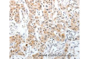 Immunohistochemistry of Human lung cancer using SLC22A3 Polyclonal Antibody at dilution of 1:40 (OCT4 抗体)