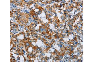Immunohistochemistry of Human thyroid cancer using ETHE1 Polyclonal Antibody at dilution of 1:20 (ETHE1 抗体)