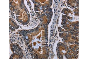Immunohistochemistry of Human colon cancer using SLC1A6 Polyclonal Antibody at dilution of 1:40 (SLC1A6 抗体)