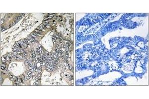 Immunohistochemistry analysis of paraffin-embedded human colon carcinoma tissue, using GUF1 Antibody.