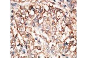 IHC analysis of FFPE human hepatocarcinoma tissue stained with the BMPR1A antibody (BMPR1A 抗体  (AA 166-196))