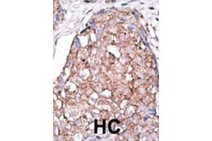 Formalin-fixed and paraffin-embedded human cancer tissue reacted with the primary antibody, which was peroxidase-conjugated to the secondary antibody, followed by AEC staining. (SIGLEC7 抗体  (C-Term))