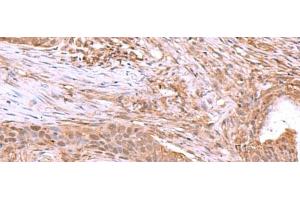 Immunohistochemistry of paraffin-embedded Human esophagus cancer tissue using JDP2 Polyclonal Antibody at dilution of 1:40(x200) (JDP2 抗体)