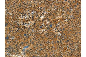 The image on the left is immunohistochemistry of paraffin-embedded Human liver cancer tissue using ABIN7191682(NPAP1 Antibody) at dilution 1/60, on the right is treated with synthetic peptide. (NPAP1 抗体)