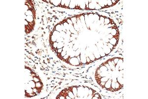 Immunohistochemistry of paraffin-embedded human colon carcinoma using Cytokeratin 13 (Cytokeratin 13 (KRT13)) antibody (ABIN7268090) at dilution of 1:100 (40x lens). (Cytokeratin 13 抗体  (AA 269-458))