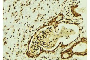 ABIN6274350 at 1/100 staining Human breast cancer tissue by IHC-P. (CBFB 抗体  (N-Term))