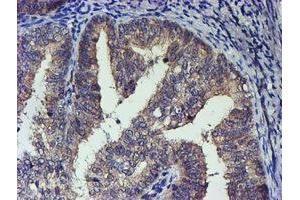 Immunohistochemical staining of paraffin-embedded Adenocarcinoma of Human endometrium tissue using anti-TCP11L2 mouse monoclonal antibody. (TCP11L2 抗体)