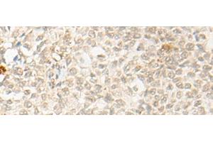Immunohistochemistry of paraffin-embedded Human ovarian cancer tissue using OTX1 Polyclonal Antibody at dilution of 1:30(x200) (OTX1 抗体)