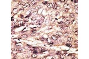 IHC analysis of FFPE human hepatocarcinoma tissue stained with the ATG7 antibody (ATG7 抗体  (AA 494-523))