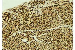 ABIN6269272 at 1/100 staining Human breast cancer tissue by IHC-P. (CEBPA 抗体  (N-Term))