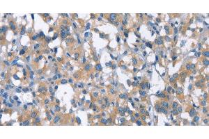 Immunohistochemistry of paraffin-embedded Human thyroid cancer using CDC25A Polyclonal Antibody at dilution of 1:50 (CDC25A 抗体)