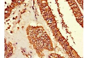 Immunohistochemistry of paraffin-embedded human endometrial cancer using ABIN7173699 at dilution of 1:100 (TUBG1 抗体  (AA 29-184))