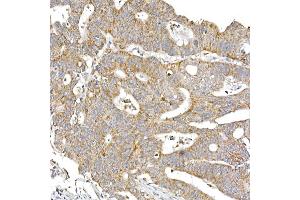Immunohistochemistry of paraffin-embedded human colon carcinoma using S Rabbit mAb (ABIN7270501) at dilution of 1:250 (40x lens). (SAMM50 抗体)