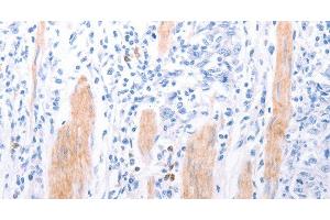 Immunohistochemistry of paraffin-embedded Human gasrtic cancer tissue using LPAR2 Polyclonal Antibody at dilution 1:40 (EDG4 抗体)