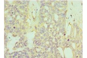 Immunohistochemistry of paraffin-embedded human endommetrial cancer using ABIN7155969 at dilution of 1:100 (HYAL1 抗体  (AA 136-435))