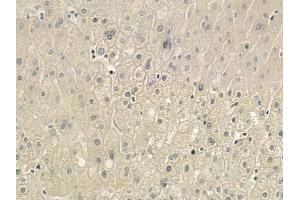 ABIN6264775 and ABIN6276503 at 1/100 staining human gastric carcinoma by IHC-P.