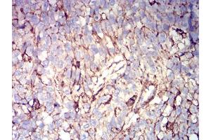 Immunohistochemical analysis of paraffin-embedded bladder cancer tissues using CD44 mouse mAb with DAB staining. (CD44 抗体  (AA 36-194))