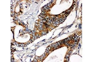 IHC-P: Laminin gamma 1 antibody testing of human intestinal cancer tissue (Laminin gamma 1 抗体  (AA 1566-1579))