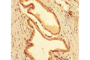 Immunohistochemistry of paraffin-embedded human prostate cancer using ABIN7155782 at dilution of 1:100 (MEIS1 抗体  (AA 1-90))