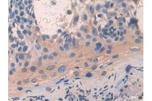 Detection of ARRb1 in Human Skin cancer Tissue using Polyclonal Antibody to Arrestin Beta 1 (ARRb1)