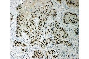 IHC-P: p63 antibody testing of human esophageal squamous cell carcinoma tissue (TCP1 alpha/CCTA 抗体  (AA 82-98))