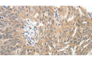Immunohistochemistry of paraffin-embedded Human ovarian cancer tissue using E-Selectin Polyclonal Antibody at dilution of 1:40 (Selectin E/CD62e 抗体)
