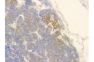LAT Antibody at 1/100 staining human thymoma by IHC-P. (LAT 抗体  (C-Term))