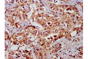IHC image of ABIN7154482 diluted at 1:1000 and staining in paraffin-embedded human liver cancer performed on a Leica BondTM system. (GAS2 抗体  (AA 1-141))