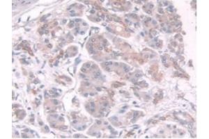 IHC-P analysis of Human Pancreas Cancer Tissue, with DAB staining. (TPMT 抗体  (AA 26-227))