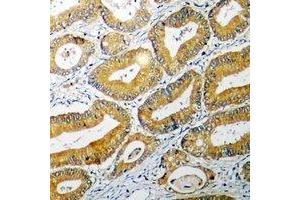 Immunohistochemical analysis of BID staining in human colon cancer formalin fixed paraffin embedded tissue section.