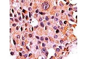 IHC analysis of FFPE human breast carcinoma tissue stained with the Calcineurin antibody (CAN 抗体  (AA 21-51))