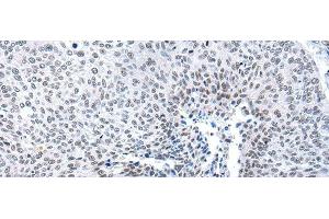 Immunohistochemistry of paraffin-embedded Human lung cancer tissue using MORC2 Polyclonal Antibody at dilution of 1:25(x200) (MORC2 抗体)