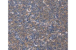 Immunohistochemistry of Human liver cancer using CD5L Polyclonal Antibody at dilution of 1:40 (CD5L 抗体)