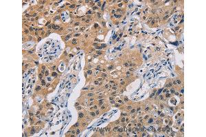 Immunohistochemistry of Human lung cancer using TLR3 Polyclonal Antibody at dilution of 1:50 (TLR3 抗体)