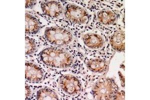 Immunohistochemical analysis of EPS8L1 staining in human colon cancer formalin fixed paraffin embedded tissue section. (EPS8-Like 1 抗体)