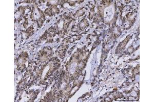 IHC analysis of MLH1 using anti-MLH1 antibody (ABIN7599691). (MLH1 抗体  (AA 108-756))