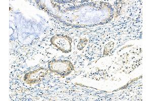 ABIN6259590 and ABIN6275930 at 1/100 staining Human gastric cancer by IHC-P. (BUD31 抗体  (N-Term))